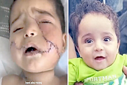 اسرائیلی بمباری میں ننھا زخمی، چہرہ پر 200ٹانکے لگے